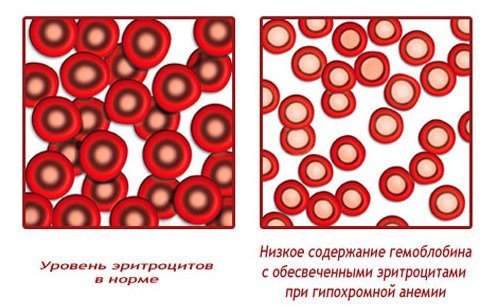 Норма анизоцитоза в общем анализе крови